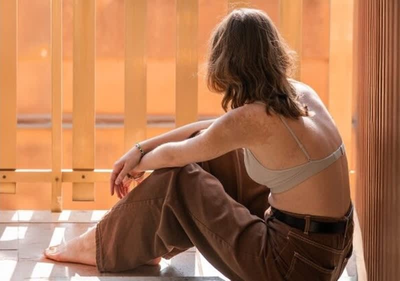 Donna seduta in balcone con pantaloni larghi e top e macchie pigmentate sul corpo
