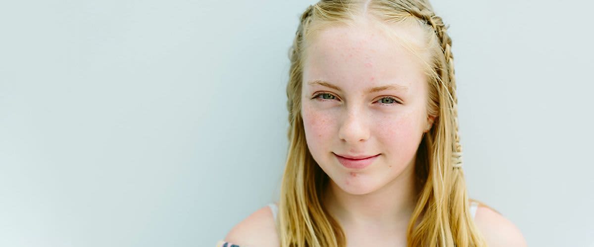 Dziewczyna z niedoskonałościami skóry