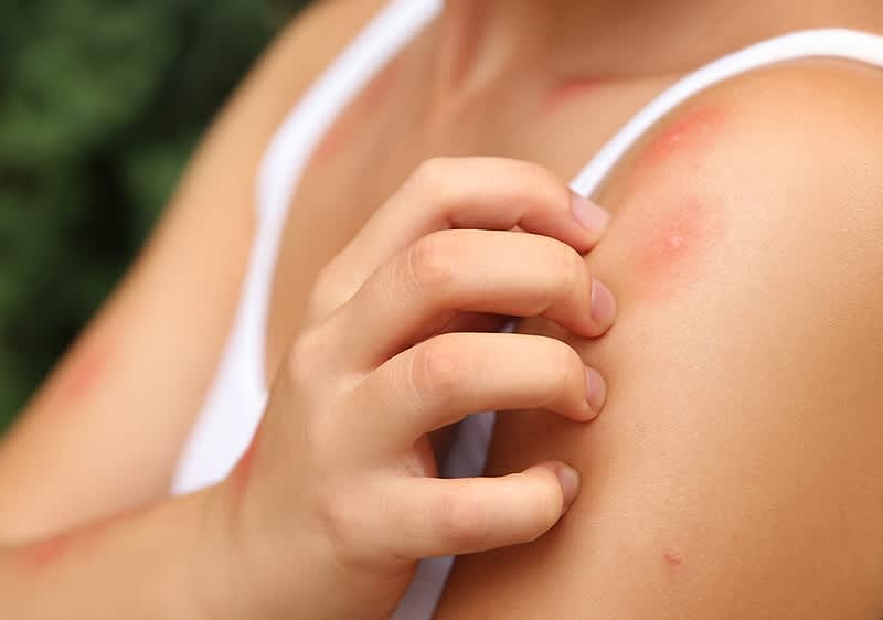 Domowe sposoby na ukąszenia komarów