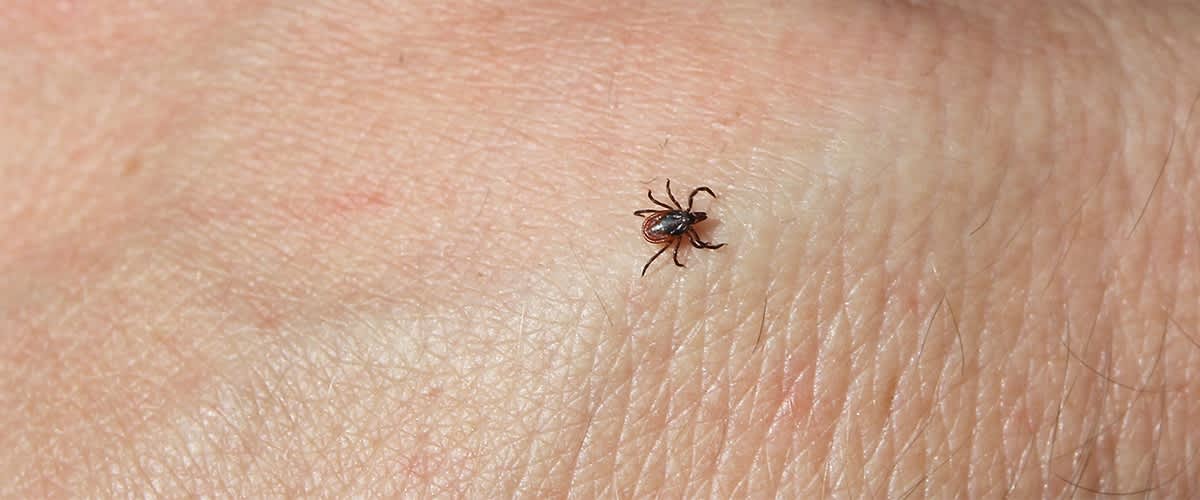 Căpușă pe pielea unei persoane