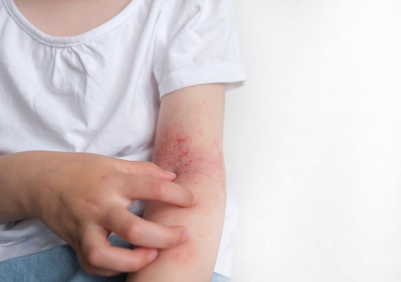 Atopická dermatitída