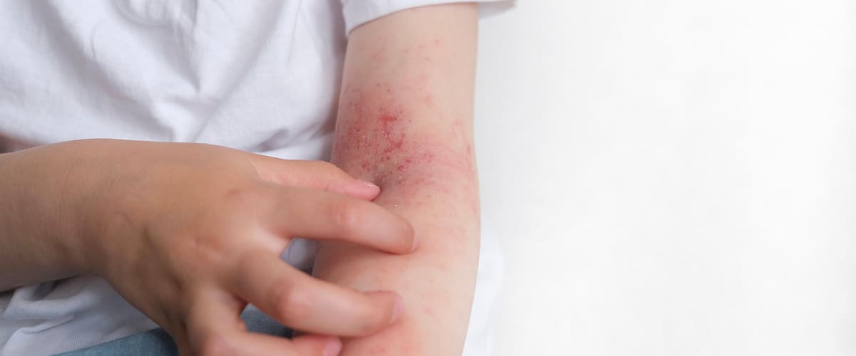 Atopická dermatitída