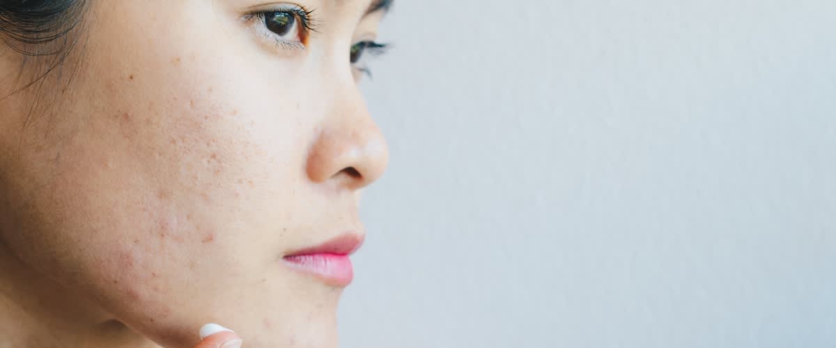 žena s akné na tvári si natiera krém na tvár