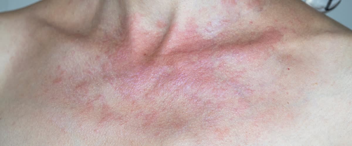 letné akné na dekolte ženy