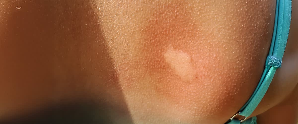 Alt-Text: Kožni izpuščaj na roki z rdečico in svetlim madežem