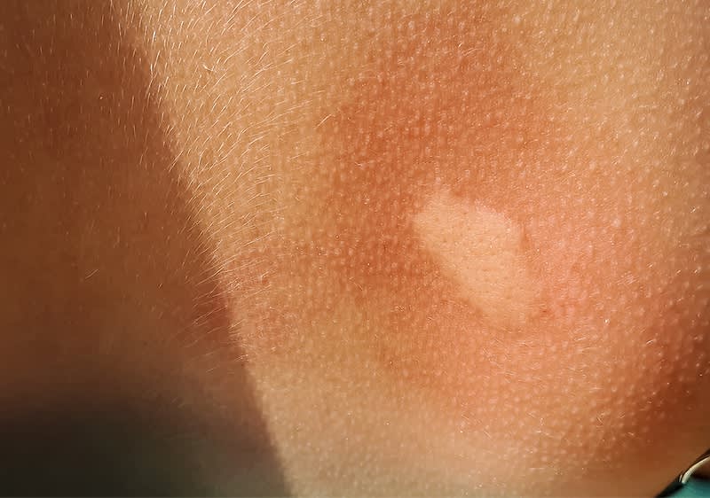 Alt-Text: Kožni izpuščaj na roki z rdečico in svetlim madežem