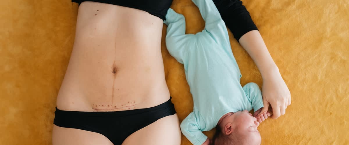 Frau mit Kaiserschnittnarbe liegt neben Baby