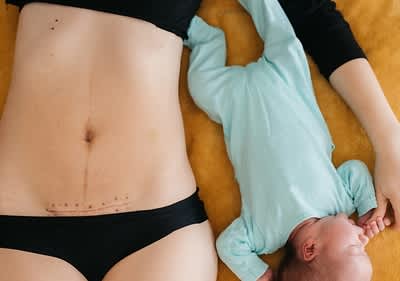 Frau mit Kaiserschnittnarbe liegt neben Baby