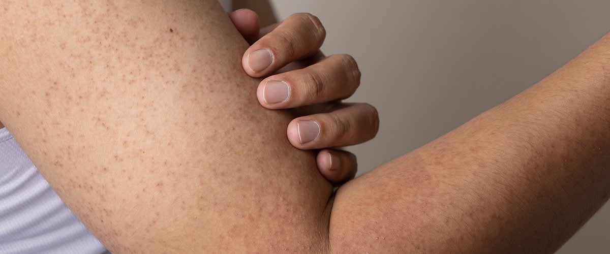 Slika koja prikazuje ruku koja grli nadlakticu sa sitnim crvenim tačkicama na koži ključna reč: kožne pege