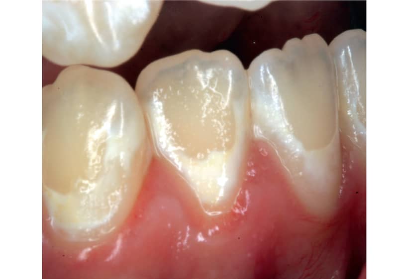 Слика: Бели дамки на забите - први симптоми на кариес.