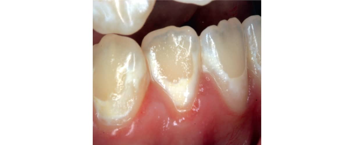 Слика: Бели дамки на забите - први симптоми на кариес. 